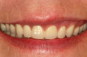 Smile After Treatment