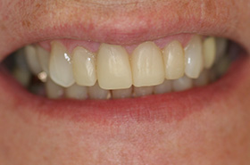 Smile After Treatment